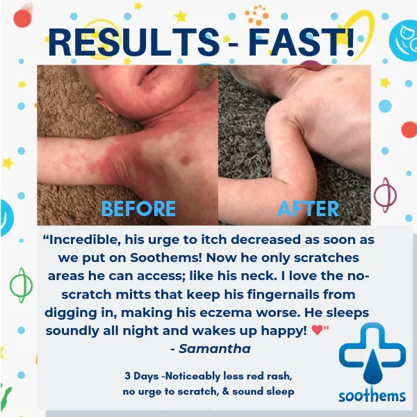 Soothems Eczema Cradle Cap for Babies | Sleep Cap May Also Be Used for Wet Wrap Therapy | Itch Relief Clothing