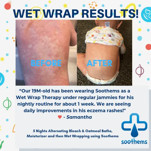 Soothems Eczema Cradle Cap for Babies | Sleep Cap May Also Be Used for Wet Wrap Therapy | Itch Relief Clothing