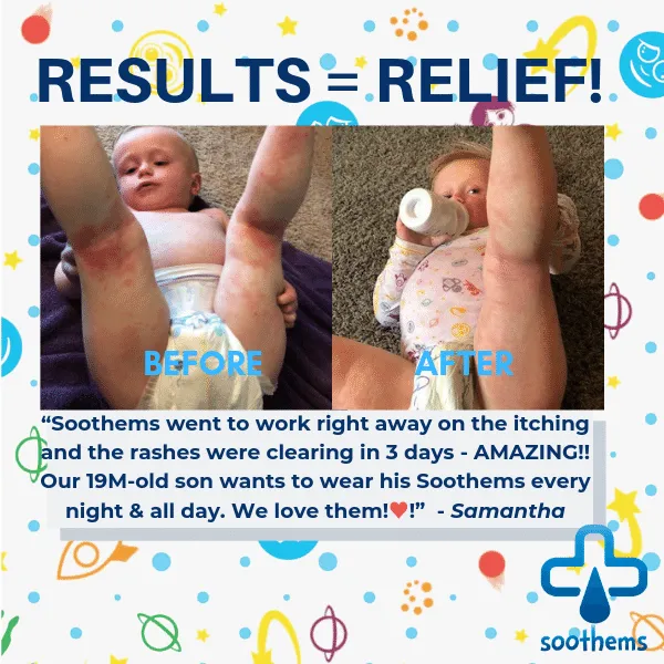 Soothems Eczema Cradle Cap for Babies | Sleep Cap May Also Be Used for Wet Wrap Therapy | Itch Relief Clothing
